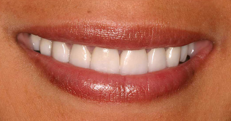 Image of a bright, shiny smile.