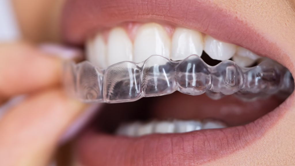 Clear Aligners: Answers to Common Questions